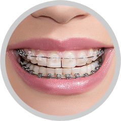 Walden Orthodontics | SE Calgary Orthodontic | Traditional Braces