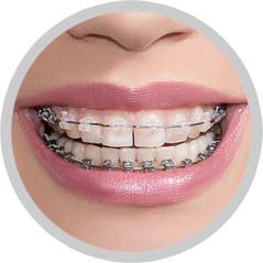 Walden Orthodontics | SE Calgary Orthodontic | Traditional Braces