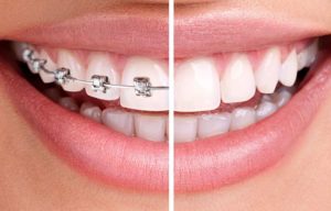 Walden Orthodontics | SE Calgary Orthodontist | Braces Before and After