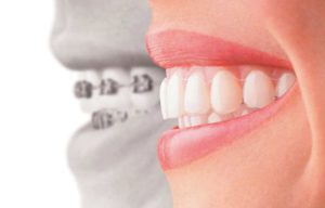 Walden Orthodontics | SE Calgary Orthodontist | Invisalign Versus Traditional Braces
